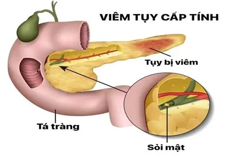 Nguy cơ viêm tụy cấp do rượu bia dịp Tết và dấu hiệu nhận biết
